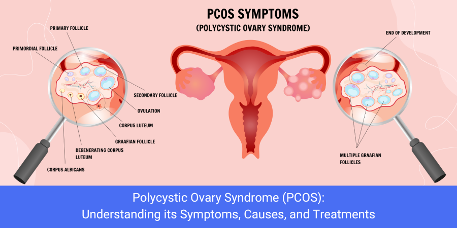Polycystic Ovary Syndrome (PCOS): Understanding its Symptoms, Causes, and Treatments